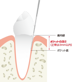 歯周ポケット