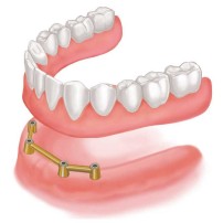 全ての歯を失った方のインプラント治療